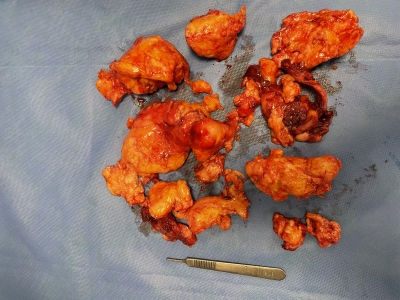 Laparoscopic management of uterine fibroids, myomas, which patients are eligible?